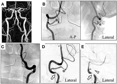 Case Report: Bow Hunter's Syndrome Caused by Compression of Extracranially Originated Posterior Inferior Cerebellar Artery